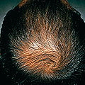 プロペシアの治療効果：男性型脱毛症に効果のある飲み薬 プロペシア～山本可菜子皮フ科クリニック～