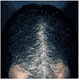 プロペシアの治療効果：男性型脱毛症に効果のある飲み薬 プロペシア～山本可菜子皮フ科クリニック～